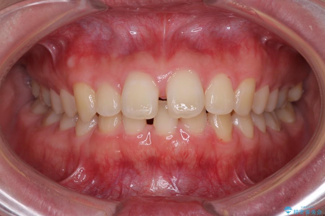 上の前歯の出っ歯と隙間インビザライン矯正 治療例 治療前