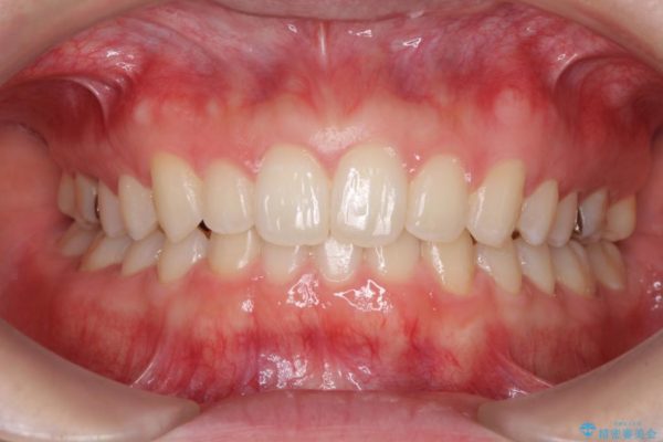 上の前歯の出っ歯と隙間インビザライン矯正 治療例 アフター