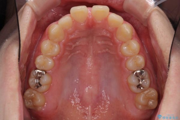 上の前歯の出っ歯と隙間インビザライン矯正 治療例 治療前画像