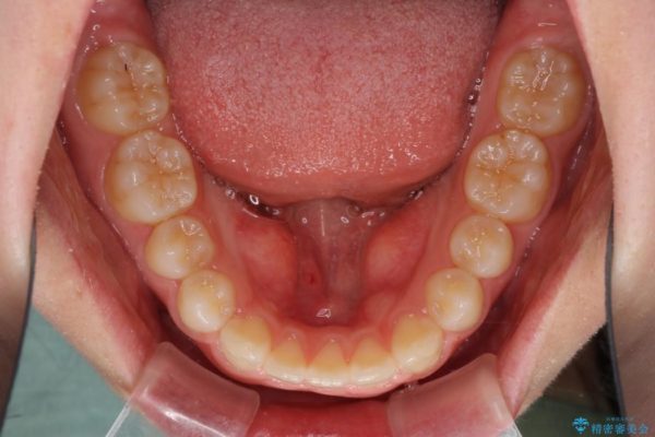 上の前歯の出っ歯と隙間インビザライン矯正 治療例 治療後画像