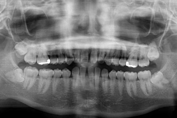 上の前歯の出っ歯と隙間インビザライン矯正 治療例 治療前画像