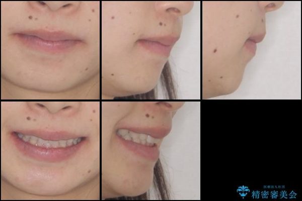 上の前歯の出っ歯と隙間インビザライン矯正 治療例 治療後画像