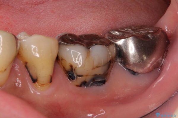 奥歯のオールセラミック 治療例 ビフォー