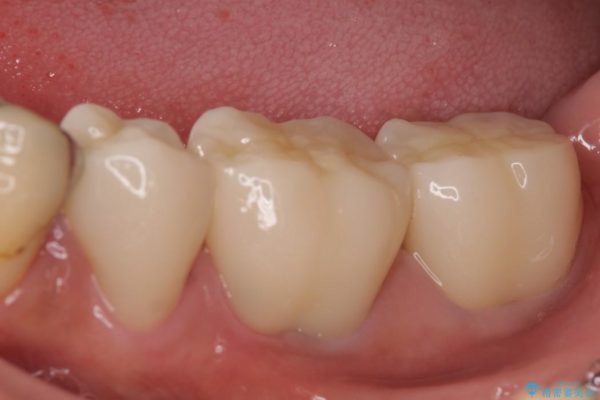 奥歯のオールセラミック 治療例 治療後画像