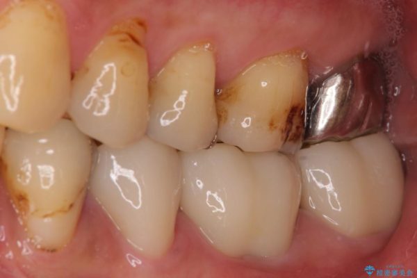 奥歯のオールセラミック 治療例 治療後画像