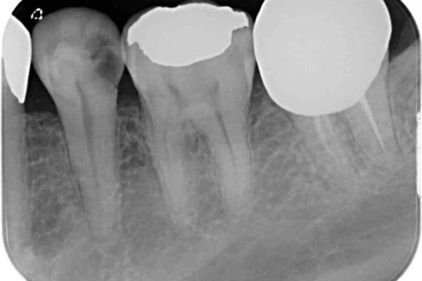 奥歯のオールセラミック 治療例 治療前画像