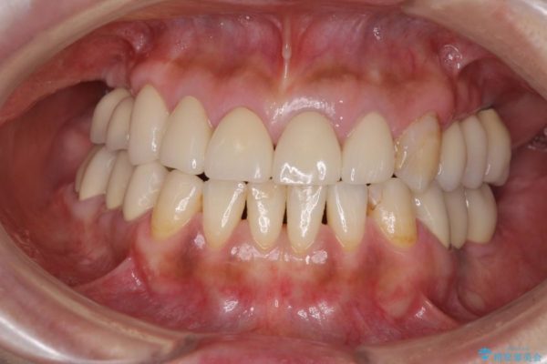 奥歯で噛めるようになったインプラント治療 治療後画像