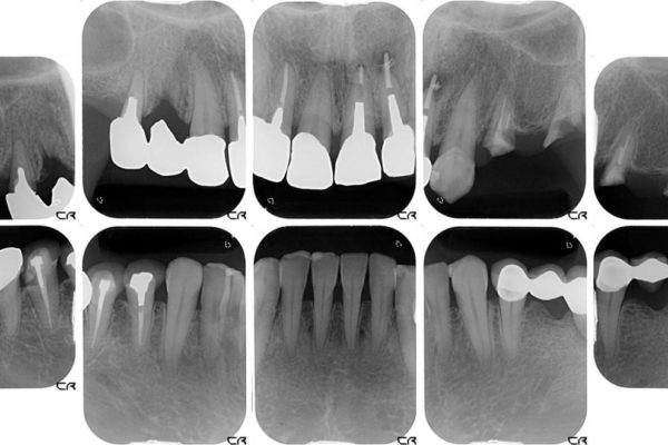 奥歯で噛めるようになったインプラント治療 治療前画像