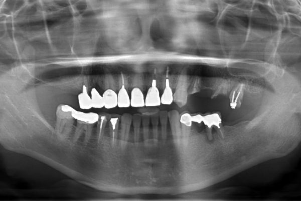 奥歯で噛めるようになったインプラント治療 治療前画像