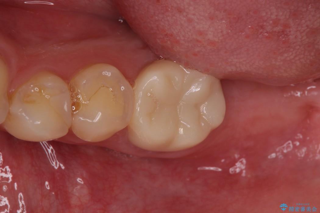 奥歯のストローマン・インプラント 治療例 治療前