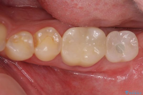 奥歯のストローマン・インプラント 治療例 アフター