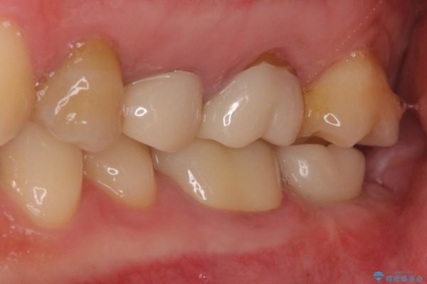 奥歯のストローマン・インプラント 治療例 治療前画像