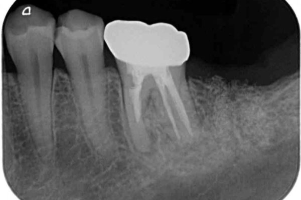奥歯のストローマン・インプラント 治療例 治療前画像