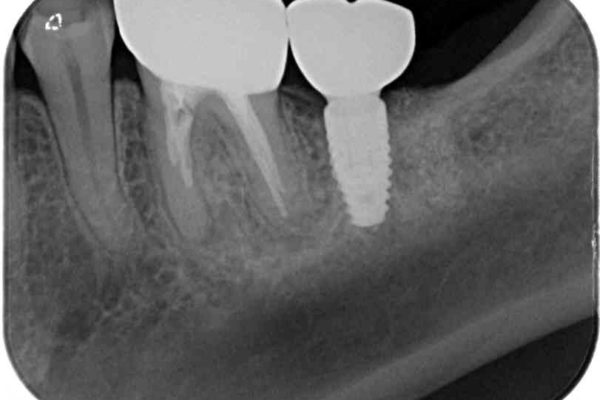 奥歯のストローマン・インプラント 治療例 治療後画像