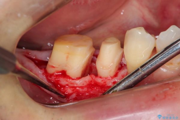 歯周病が原因で失われた奥歯の骨の再生治療 治療前画像