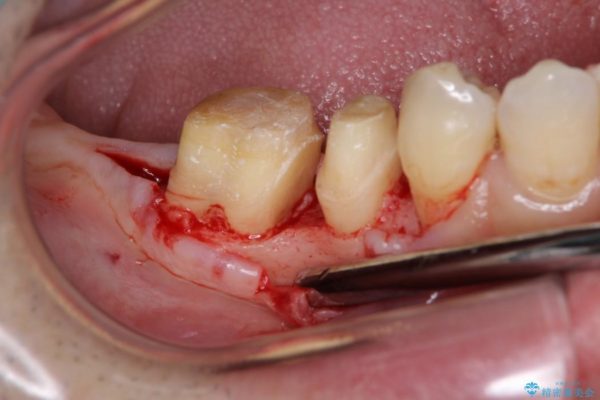歯周病が原因で失われた奥歯の骨の再生治療 アフター