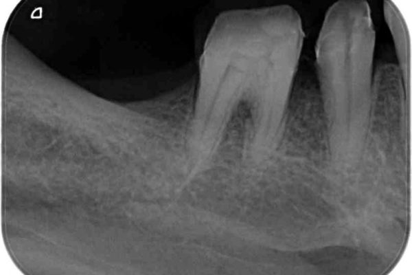 歯周病が原因で失われた奥歯の骨の再生治療 治療後画像
