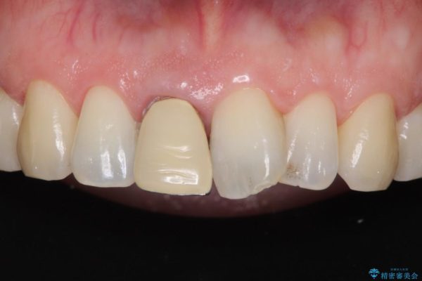 前歯のねじれと変色のオールセラミック 治療例 ビフォー