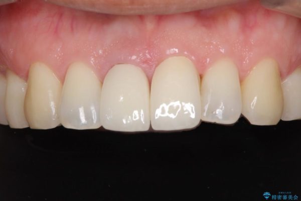 前歯のねじれと変色のオールセラミック 治療例 治療後画像