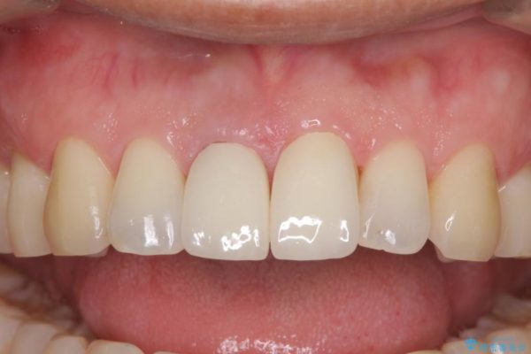 前歯のねじれと変色のオールセラミック 治療例 治療後画像