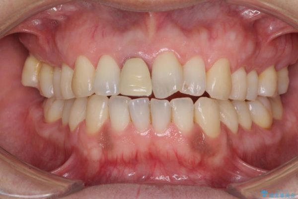 前歯のねじれと変色のオールセラミック 治療例 治療前画像