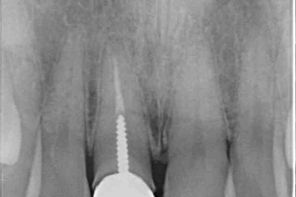 前歯のねじれと変色のオールセラミック 治療例 治療前画像
