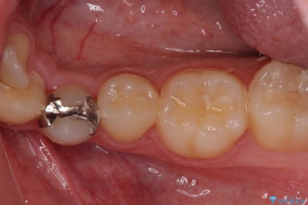 銀歯と虫歯のセラミックインレー 治療例 ビフォー