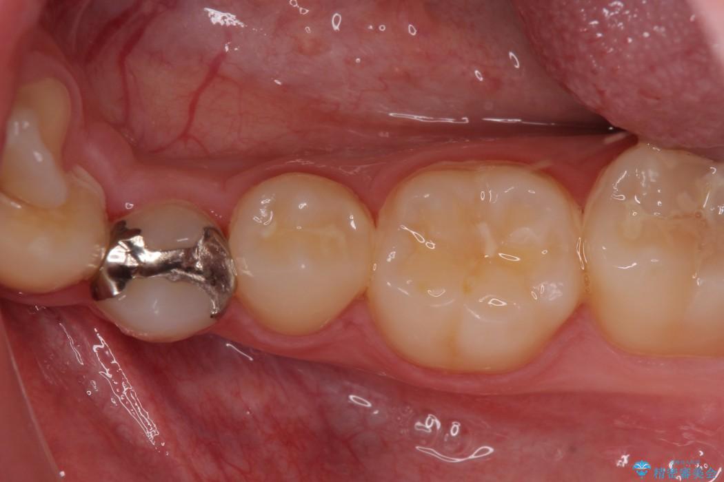 銀歯と虫歯のセラミックインレー 治療例 治療前