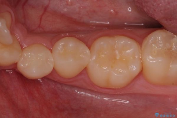 銀歯と虫歯のセラミックインレー 治療例 アフター