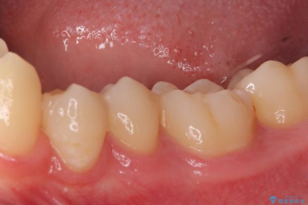 銀歯と虫歯のセラミックインレー 治療例 治療後画像