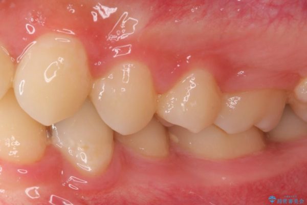 銀歯と虫歯のセラミックインレー 治療例 治療前画像