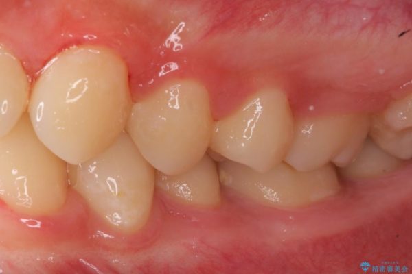 銀歯と虫歯のセラミックインレー 治療例 治療後画像