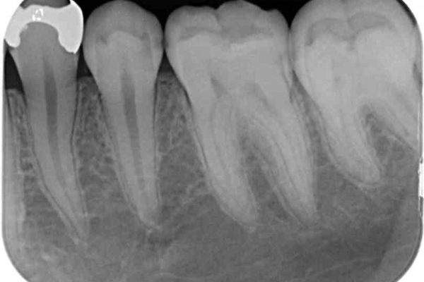 銀歯と虫歯のセラミックインレー 治療例 治療前画像