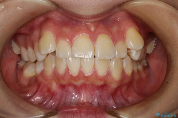 叢生（でこぼこ）と出っ歯のワイヤー矯正 治療例 ビフォー