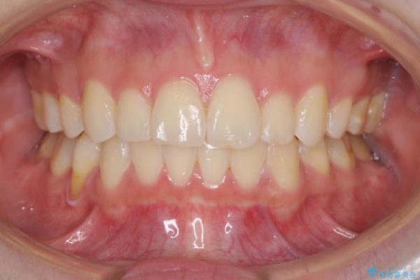 叢生（でこぼこ）と出っ歯のワイヤー矯正 治療例 治療後画像