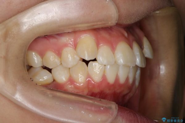 叢生（でこぼこ）と出っ歯のワイヤー矯正 治療例 治療前画像