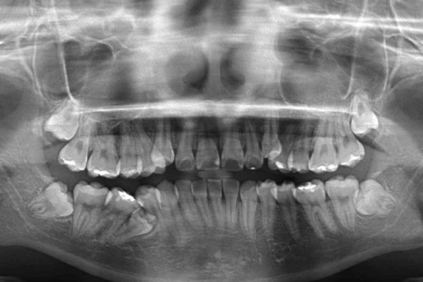 叢生（でこぼこ）と出っ歯のワイヤー矯正 治療例 治療前画像