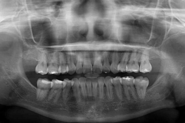 叢生（でこぼこ）と出っ歯のワイヤー矯正 治療例 治療後画像