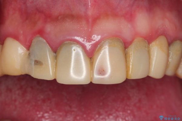 全顎の総合歯科治療 治療例 治療前画像