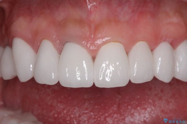 全顎の総合歯科治療 治療例 アフター