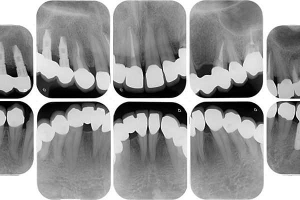 全顎の総合歯科治療 治療例 治療後画像