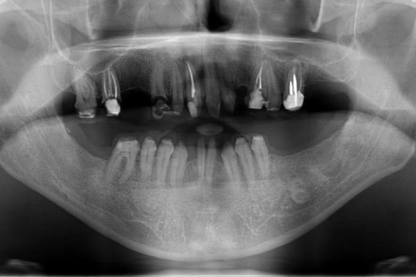 全顎の総合歯科治療 治療例 治療前画像
