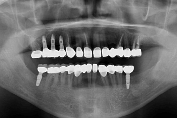 全顎の総合歯科治療 治療例 治療後画像