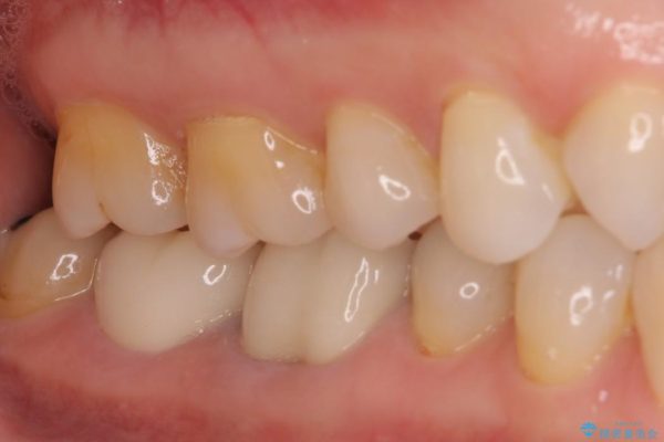 50代女性 奥歯のオールセラミック 治療例 治療後画像