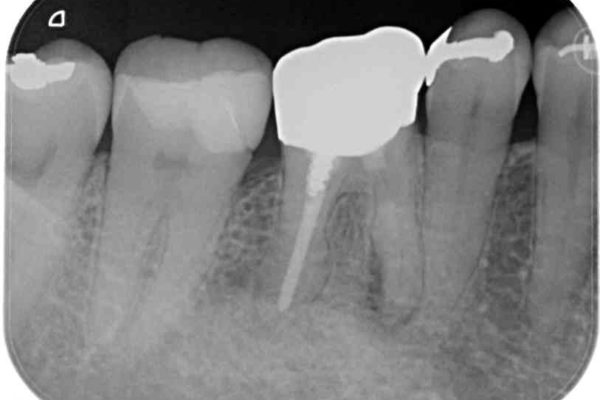 50代女性 奥歯のオールセラミック 治療例 治療前画像