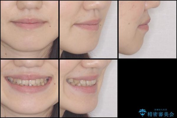 歯並びのでこぼこが気になって口を開けて笑えない　表側の目立たない装置での抜歯矯正 治療後画像