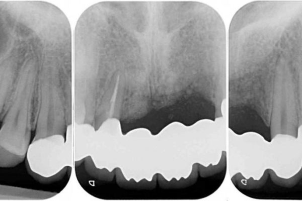 事故で抜けかけた歯　歯が溶けてしまった方の歯茎の再生、ブリッジ治療 治療後画像