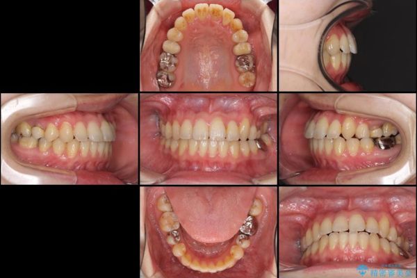 結婚式までに前歯を整えたい　上顎骨の拡大を併用した抜歯矯正 治療後画像