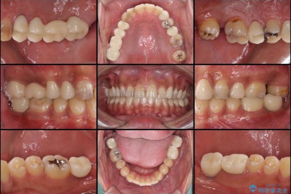 虫歯だらけの奥歯　セラミックやインプラントによる虫歯治療 治療後画像