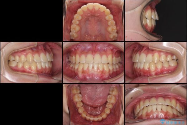 上顎の骨を拡大　抜歯せずに行う八重歯の矯正治療 治療後画像